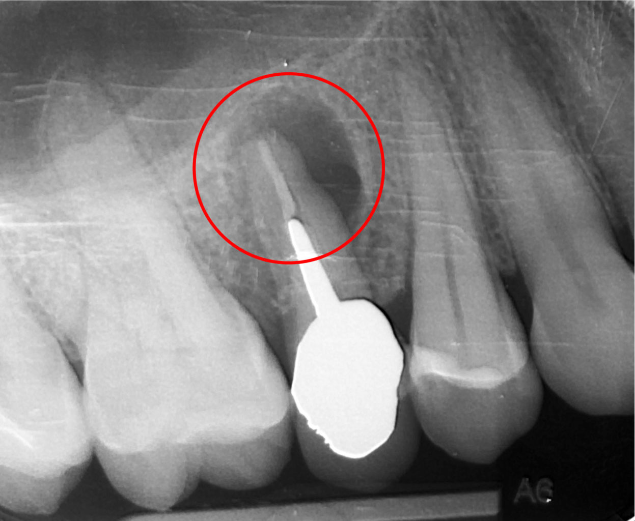 Granuloma? Cos'è e come trattarlo.