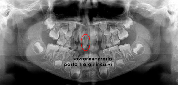 dente sovrannumerario 