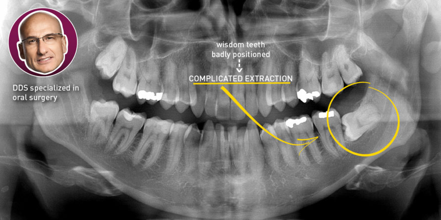 wisdom teeth