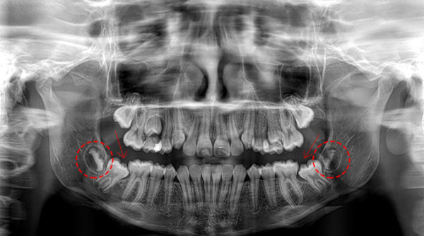 estrazione del dente del giudizio precoce