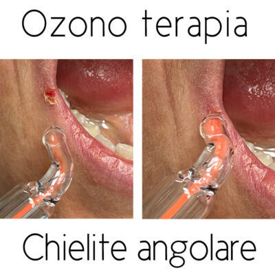 ozono terapia per chielite angolare