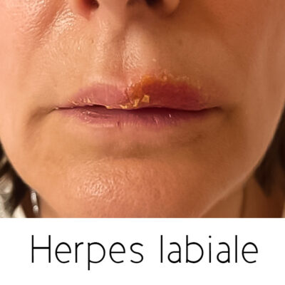 herpes labiale