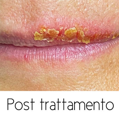 ozono terapia per Herpes labiale