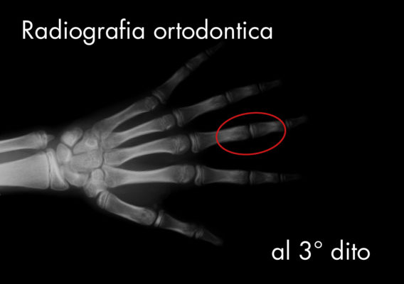 radiografia del terzo dito della mano