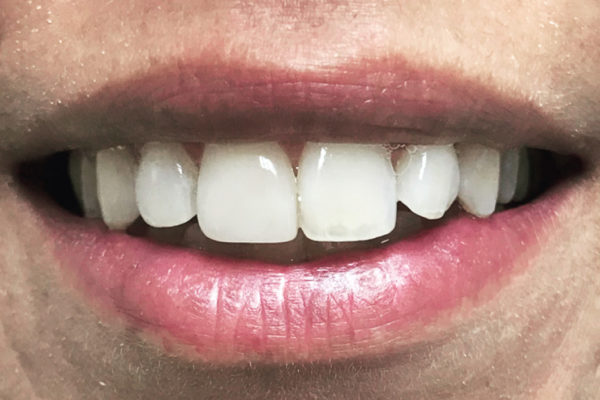 Dentisti Vignato - trattamento white spot - after