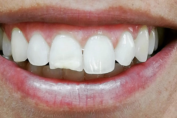 Dentisti Vignato - trattamento White spots _before