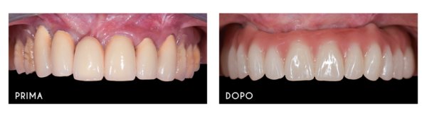 prima dopo implantologia