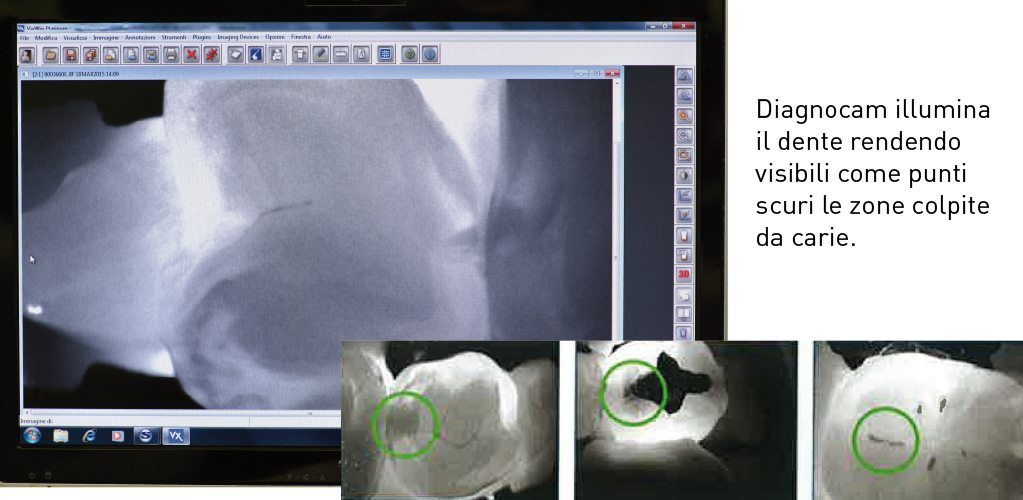 Diagnocam per la diagnosi della carie - Dentisti Vignato